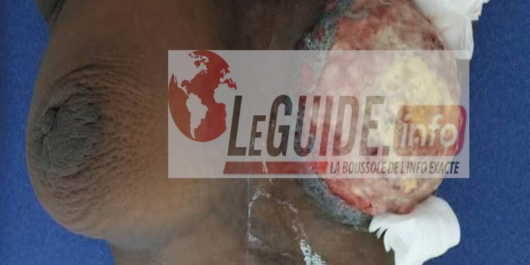 Santé : « le cancer du sein tue 400 femmes par an en Guinée, dépistez-vous », PNLCC 1 Cancer du sein
